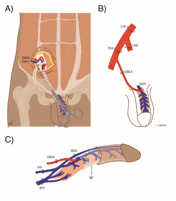 Penile arterial revascularization surgical procedure